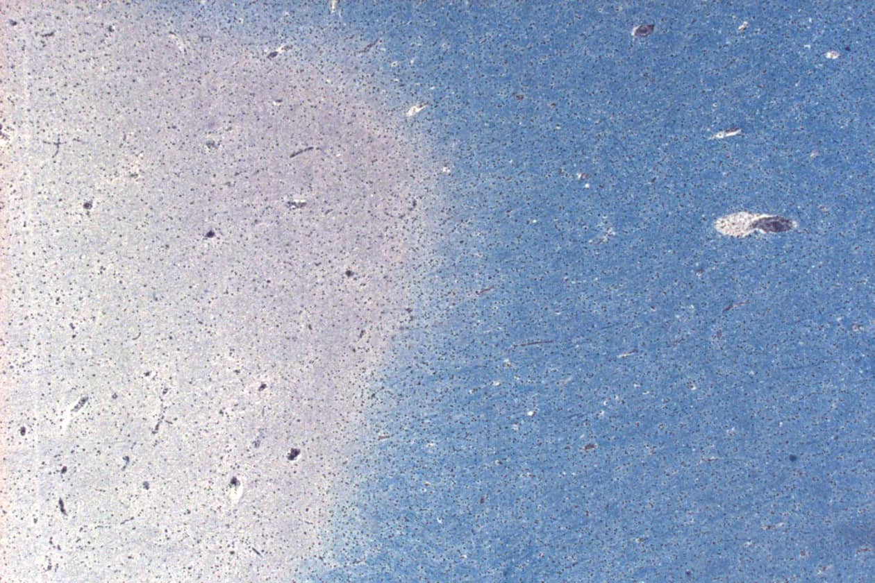 <hr>Lame histologique de substance blanche provenant d’un cas de sclérose en plaque avec coloration Bodian-Luxol (Gx20).