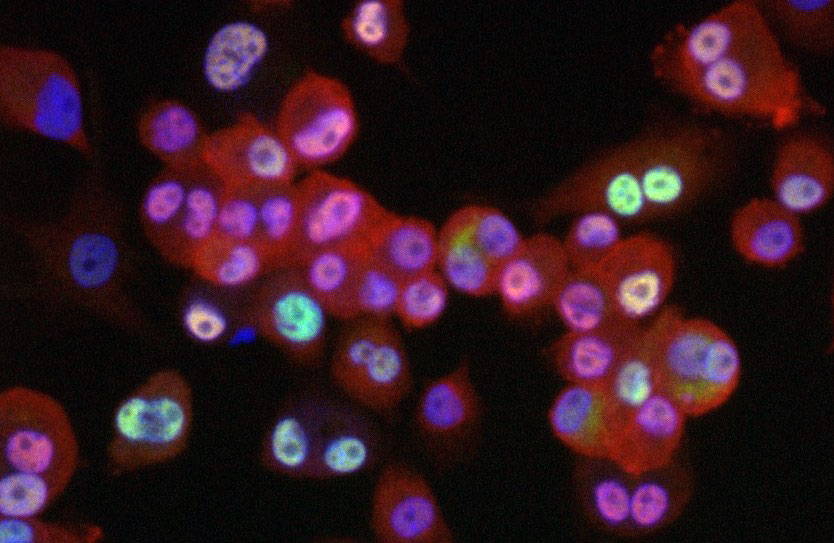 <hr>Immunofluorescence de facteurs de l’inflammation dans des cellules THP1. NFkB en rouge, cJun en vert et noyaux en bleu.